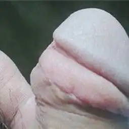 包皮过长真实图片
