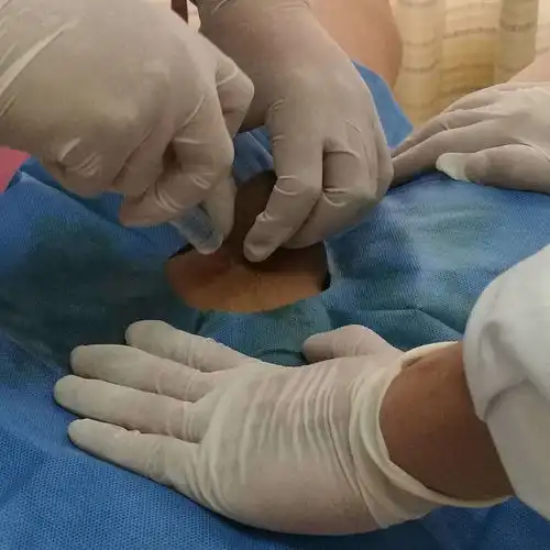 新桥医院陈医生给您讲解包皮过长包茎及包皮环切术
