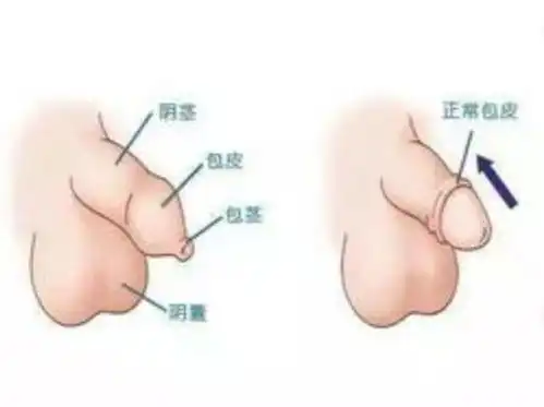 包皮过长
