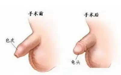 包皮过长造成的6大危害

